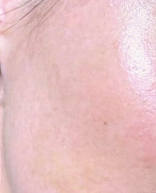 Smooth skin texture after a microneedling course