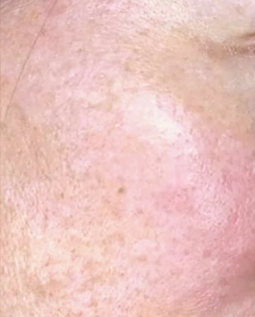Before treatment: uneven tone and sun spots