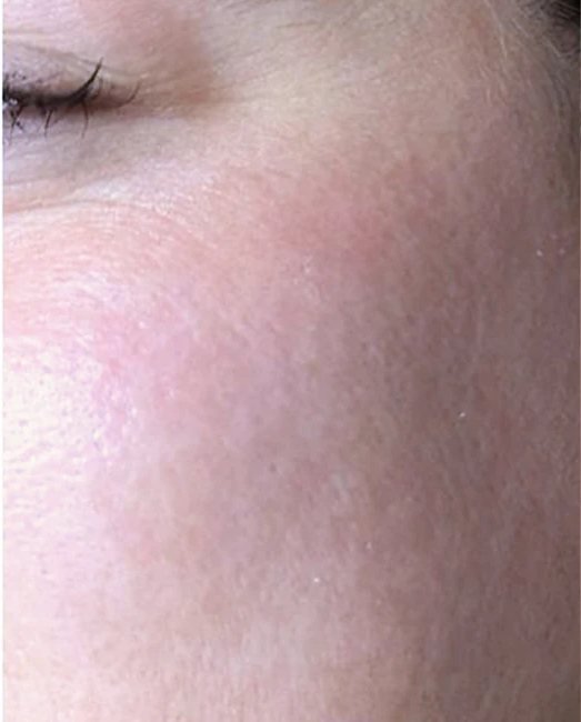 After treatment: acne scars and rough texture