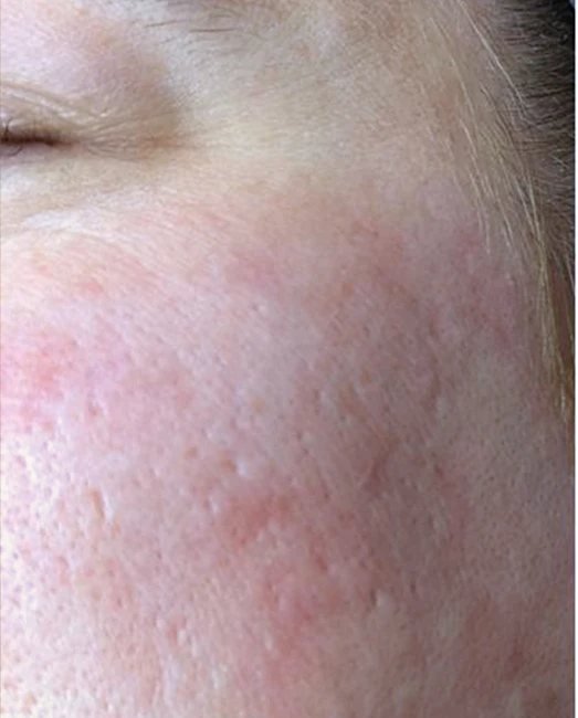Before treatment: acne scars and rough texture