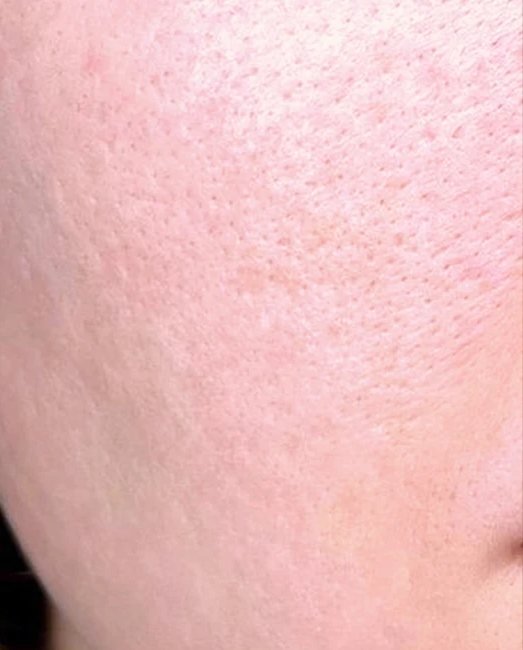 Refined pores after a carbon laser facial course