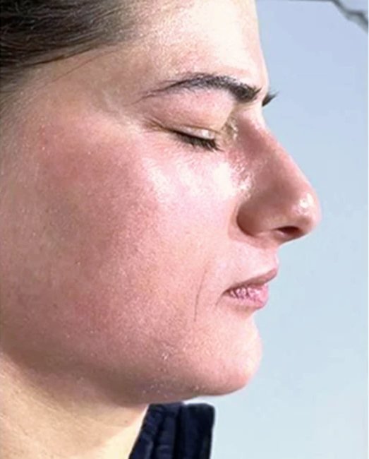After treatment: pigmentation on the cheek