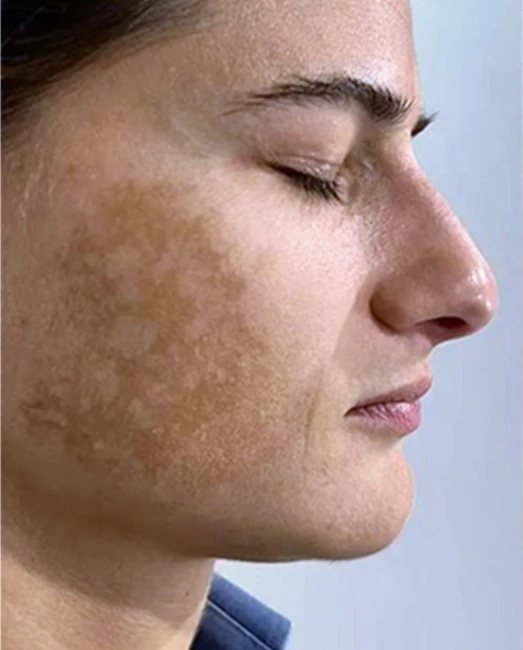 Before treatment: pigmentation on the cheek