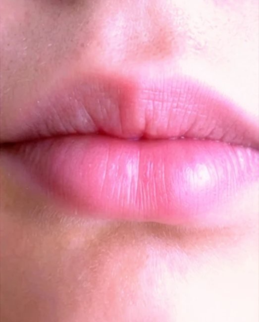 After treatment: dry, cracked lips