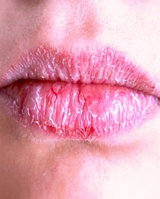 Before treatment: dry, cracked lips