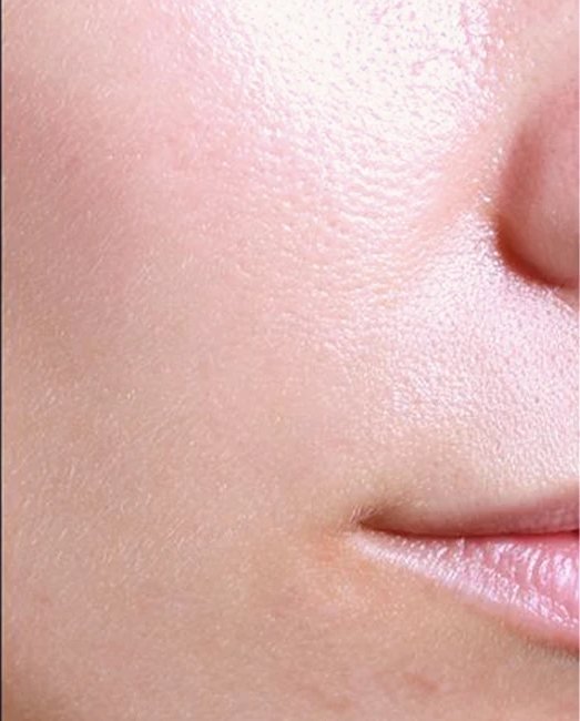 After treatment: acne and redness