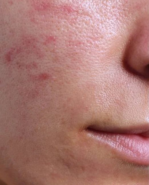 Before treatment: acne and redness