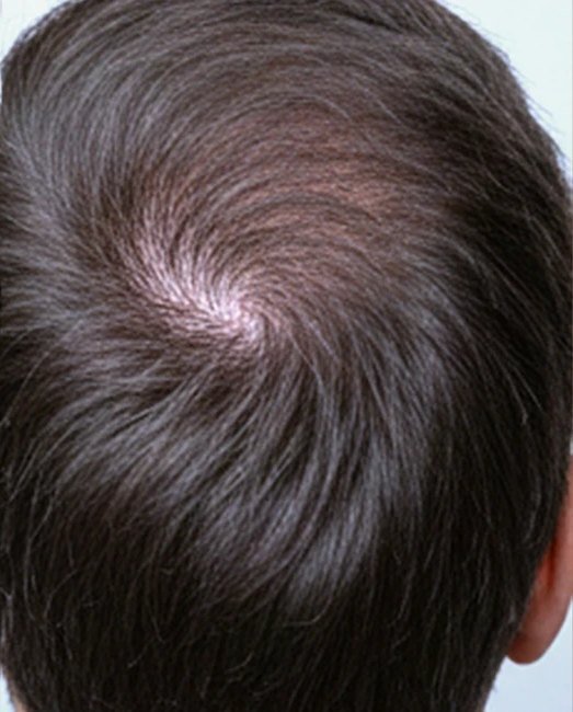 After treatment: thinning hair at the crown